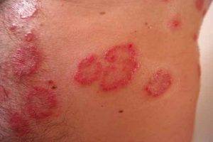 Tips For Skin Rashes